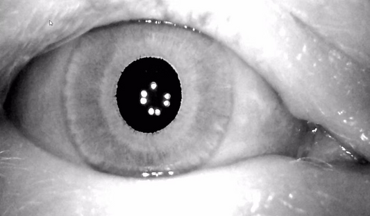 Assessment Characterisitics of Vestibular Migraine